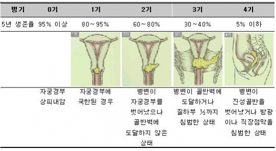 자궁암 1기, 2기, 3기, 말기별 생존률