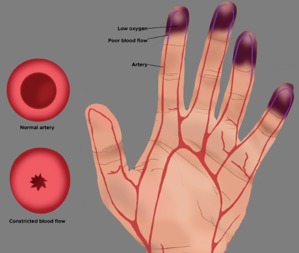 손저림과 혈액순환의 관계