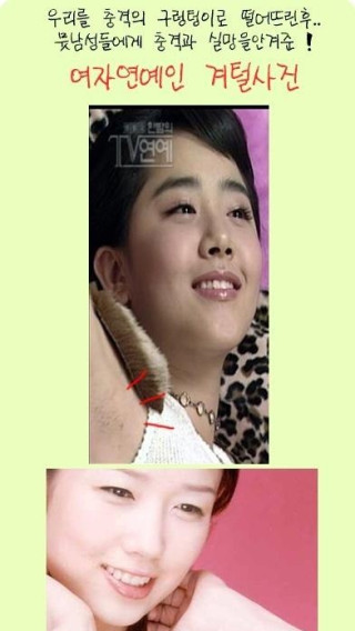 충격의 겨털사건