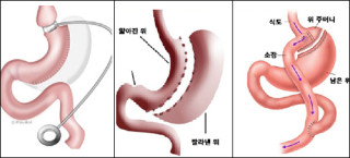 위 수술 후에 생기는 빈혈