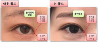 눈 수술의 대명사 쌍거풀 수술