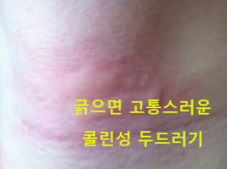 겨울철 지하철만 타면 따거움증으로 고통스럽게 하던 콜린성 두드러기 치료법
