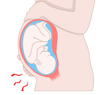 첫째가 미숙아면 둘째도 미숙아로 날 확률이 높은가?