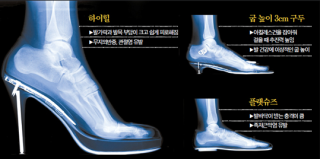 하이힐 신다 허리 디스크 걸리면?