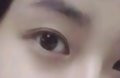 눈 성형시 절개법과 비절개법(매몰법)의 차이점