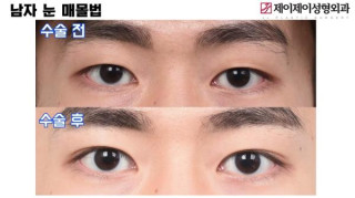 이런 사람은 매몰법 시술을 할 수 없다