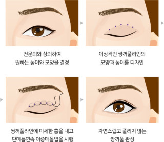 매몰법 수술에 대해 걱정하는 사람들에 대한 조언