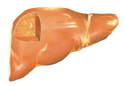 지방간(Fatty Liver)의 증상,진단,치료