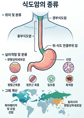 식도암의 분류 및 종류