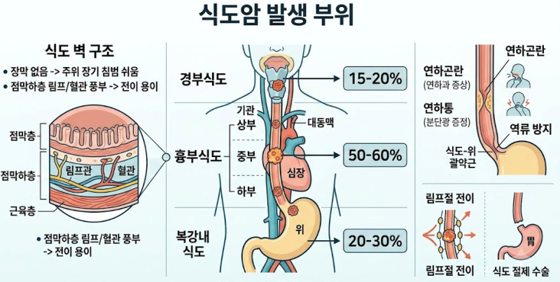 식도암이 조기 발견이 어렵고 수술 난이도가 높은 해부학적 이유