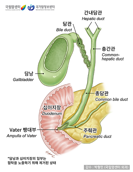 담관 선암종이라 불리우는 담낭암의 정의