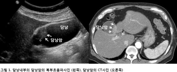 담낭암의 일반적인 증상