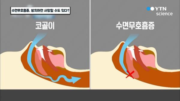폐쇄성 수면무호흡증이란