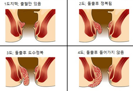 내치핵의 증상과 분류