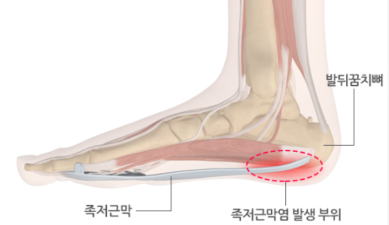 하이힐 많이 신을때 생기는병