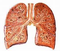 폐렴 치료 방법